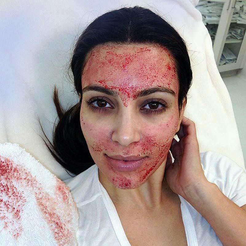 Метод омоложения лица Ким Кардашьян